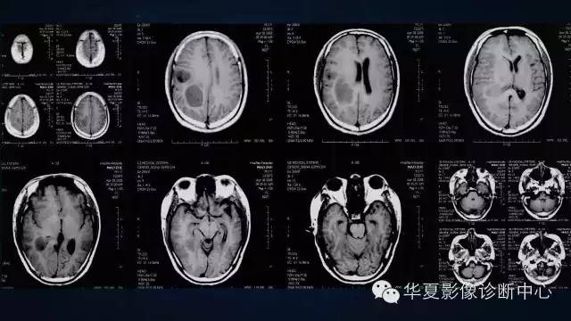 【病例】多形性胶质母细胞瘤1例MR影像表现