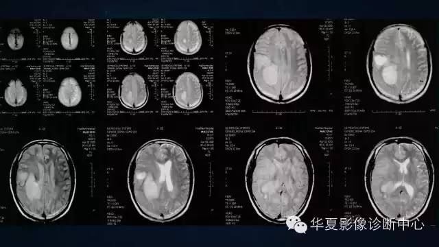 【病例】多形性胶质母细胞瘤1例MR影像表现