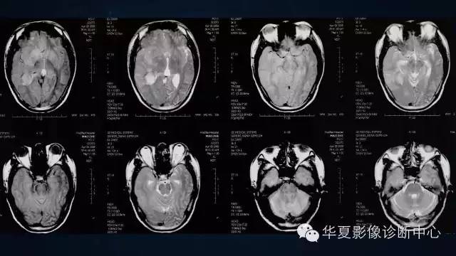 【病例】多形性胶质母细胞瘤1例MR影像表现