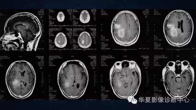 【病例】多形性胶质母细胞瘤1例MR影像表现