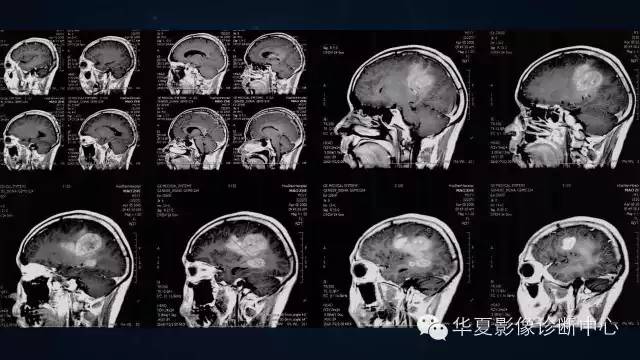 【病例】多形性胶质母细胞瘤1例MR影像表现