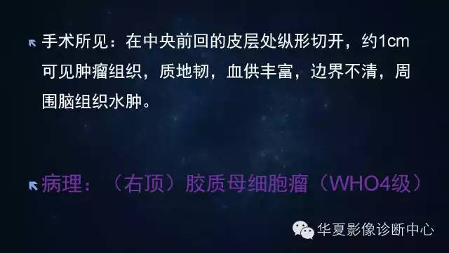 【病例】多形性胶质母细胞瘤1例MR影像表现