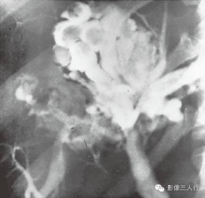 胆管囊性扩张的影像表现及鉴别诊断
