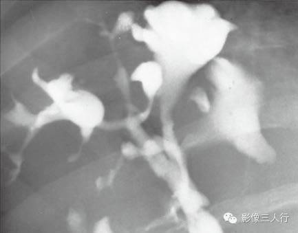 胆管囊性扩张的影像表现及鉴别诊断