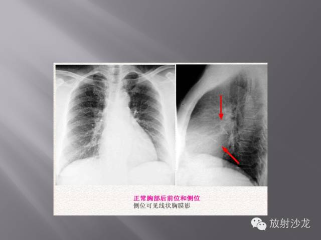 胸部正常X线、CT表现及常见病的诊断