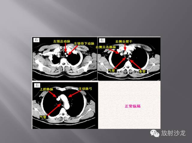 胸部正常X线、CT表现及常见病的诊断