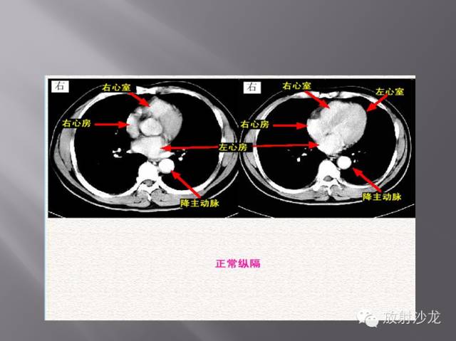 胸部正常X线、CT表现及常见病的诊断