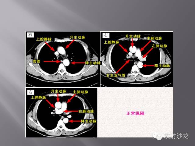 胸部正常X线、CT表现及常见病的诊断