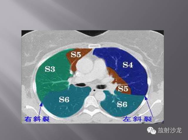 胸部正常X线、CT表现及常见病的诊断