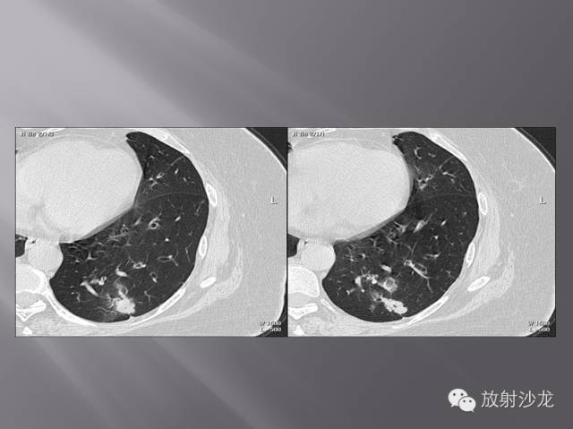 胸部正常X线、CT表现及常见病的诊断