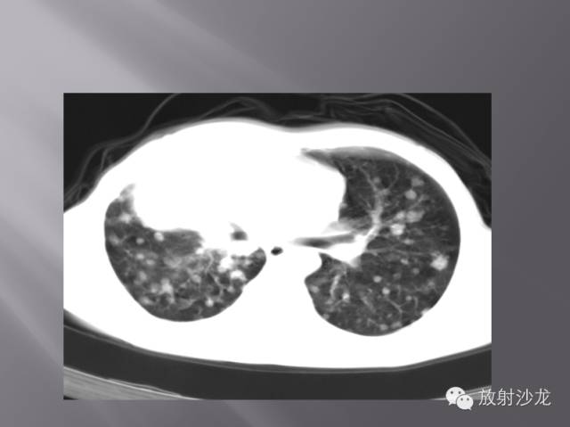 胸部正常X线、CT表现及常见病的诊断