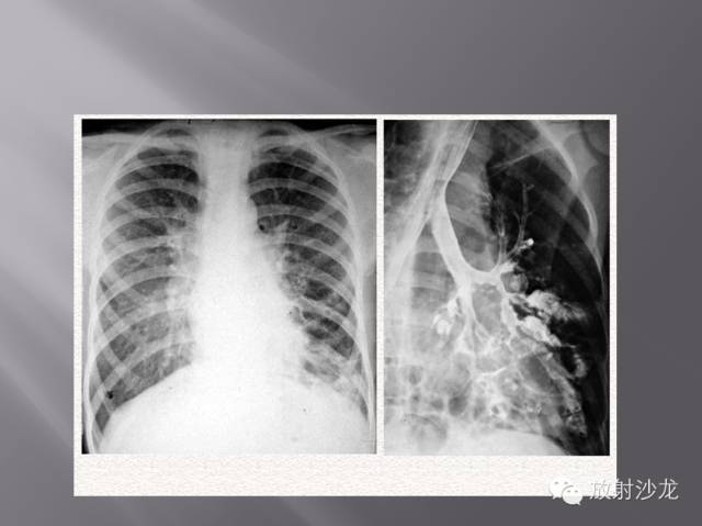 胸部正常X线、CT表现及常见病的诊断