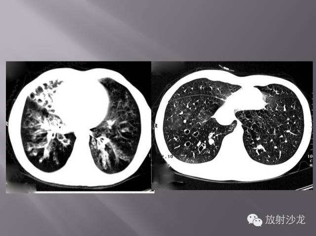 胸部正常X线、CT表现及常见病的诊断