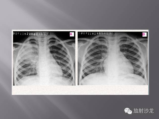 胸部正常X线、CT表现及常见病的诊断