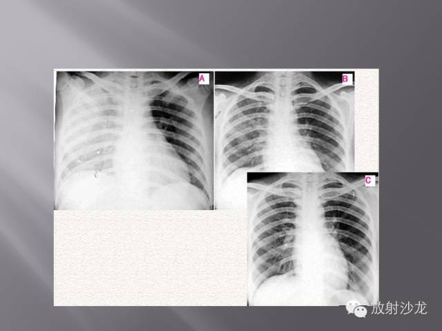 胸部正常X线、CT表现及常见病的诊断