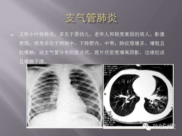 胸部正常X线、CT表现及常见病的诊断