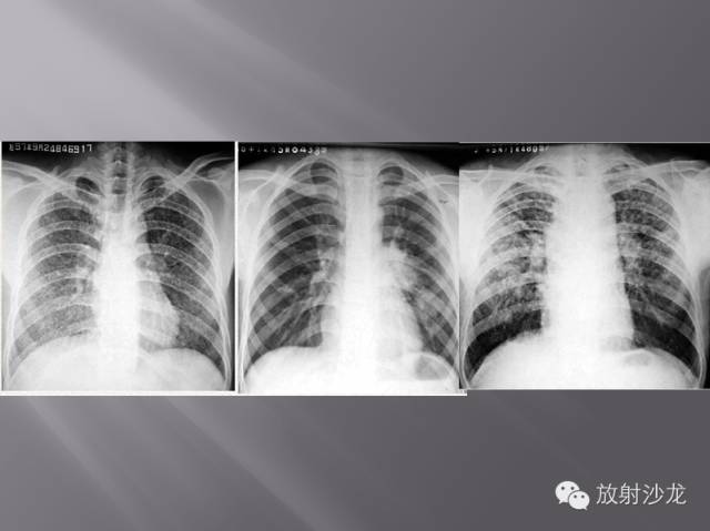 胸部正常X线、CT表现及常见病的诊断