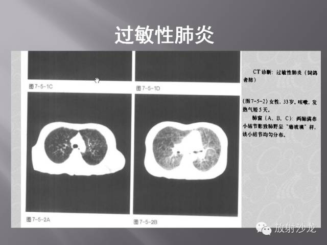 胸部正常X线、CT表现及常见病的诊断