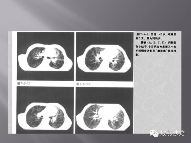 胸部正常X线、CT表现及常见病的诊断