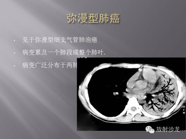 胸部正常X线、CT表现及常见病的诊断