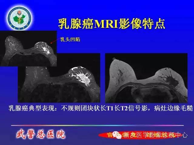【PPT】MRI对乳腺疾病的诊断
