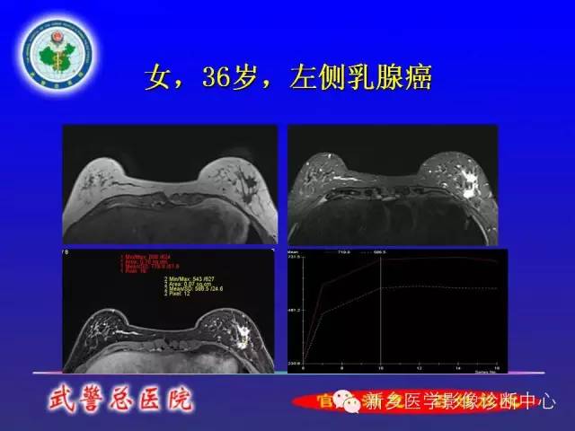 【PPT】MRI对乳腺疾病的诊断
