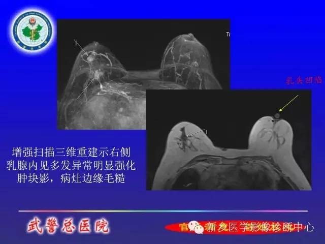 【PPT】MRI对乳腺疾病的诊断