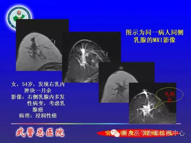 【PPT】MRI对乳腺疾病的诊断