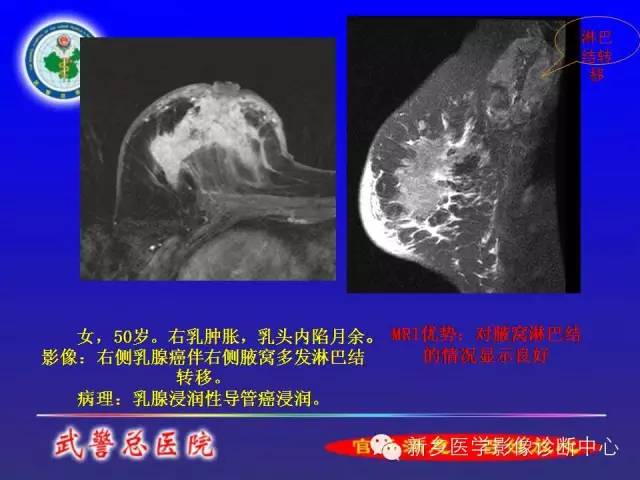 【PPT】MRI对乳腺疾病的诊断