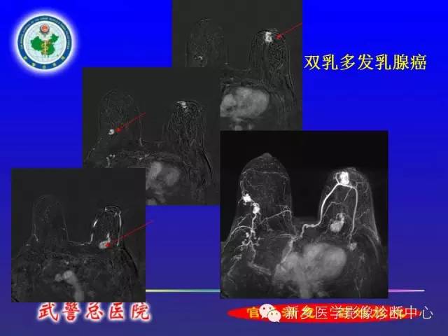 【PPT】MRI对乳腺疾病的诊断