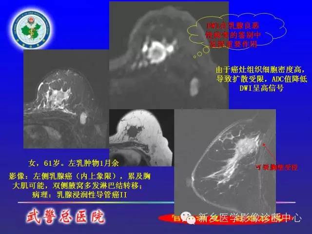 【PPT】MRI对乳腺疾病的诊断
