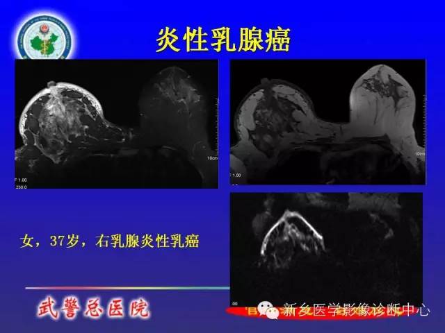 【PPT】MRI对乳腺疾病的诊断