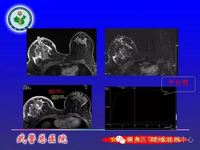 【PPT】MRI对乳腺疾病的诊断