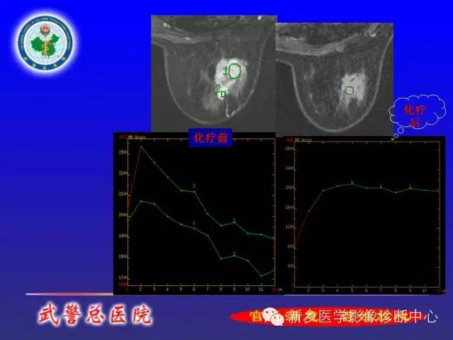 【PPT】MRI对乳腺疾病的诊断