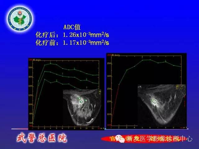 【PPT】MRI对乳腺疾病的诊断