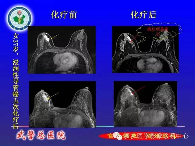 【PPT】MRI对乳腺疾病的诊断