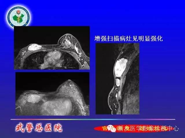 【PPT】MRI对乳腺疾病的诊断