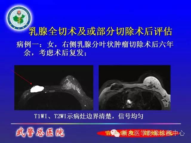 【PPT】MRI对乳腺疾病的诊断
