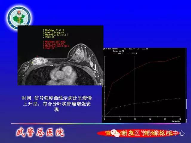 【PPT】MRI对乳腺疾病的诊断