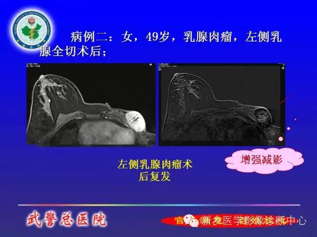 【PPT】MRI对乳腺疾病的诊断