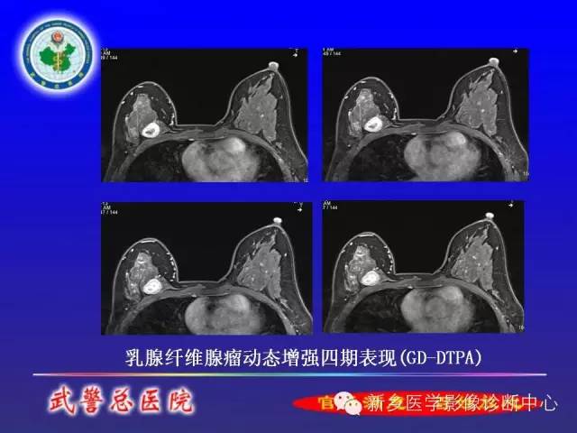 【PPT】MRI对乳腺疾病的诊断