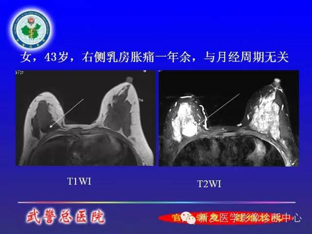 【PPT】MRI对乳腺疾病的诊断