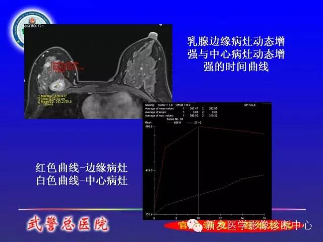 【PPT】MRI对乳腺疾病的诊断