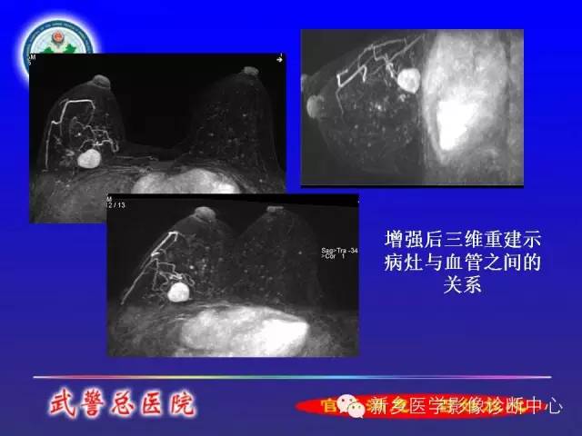 【PPT】MRI对乳腺疾病的诊断