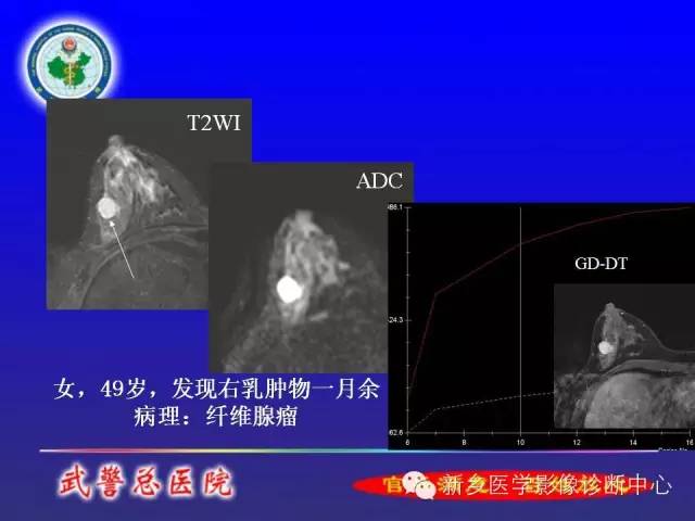 【PPT】MRI对乳腺疾病的诊断