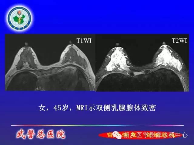 【PPT】MRI对乳腺疾病的诊断