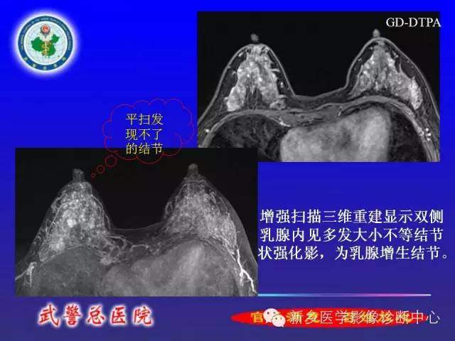 【PPT】MRI对乳腺疾病的诊断