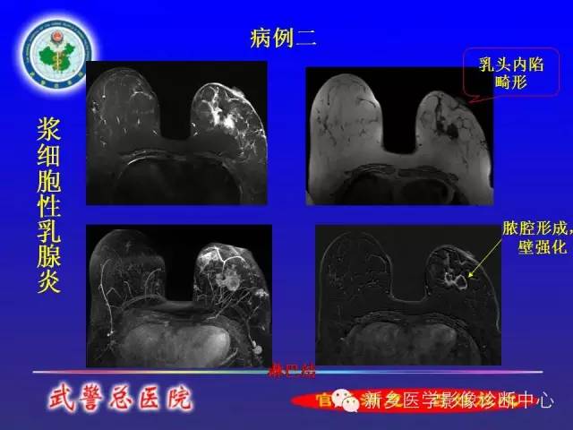 【PPT】MRI对乳腺疾病的诊断