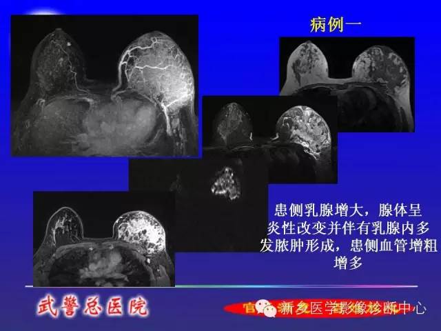【PPT】MRI对乳腺疾病的诊断