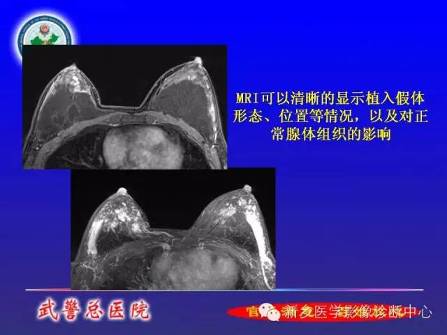 【PPT】MRI对乳腺疾病的诊断